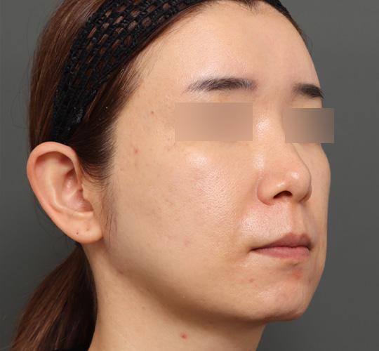 40代女性のボルニューマー After 症例写真