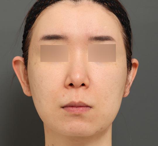 40代女性のボルニューマー Before 症例写真