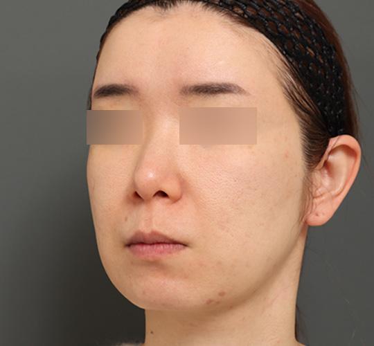 40代女性のボルニューマー Before 症例写真