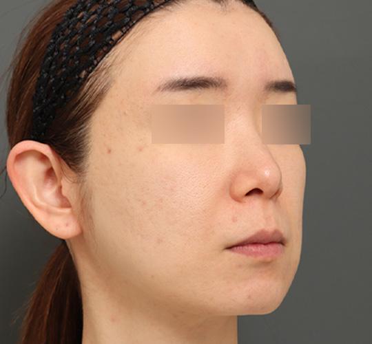 40代女性のボルニューマー Before 症例写真