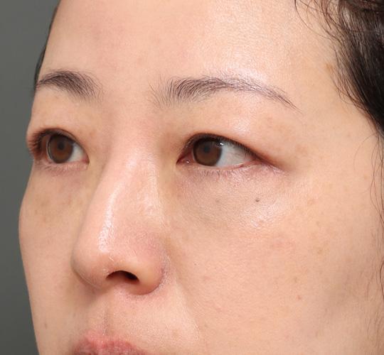 30代女性の3Dリポアイリフト  After 症例写真