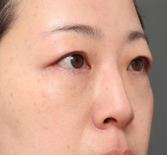 30代女性の3Dリポアイリフト  After 症例写真