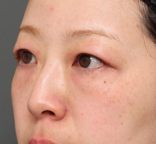 30代女性の3Dリポアイリフト  Before 症例写真