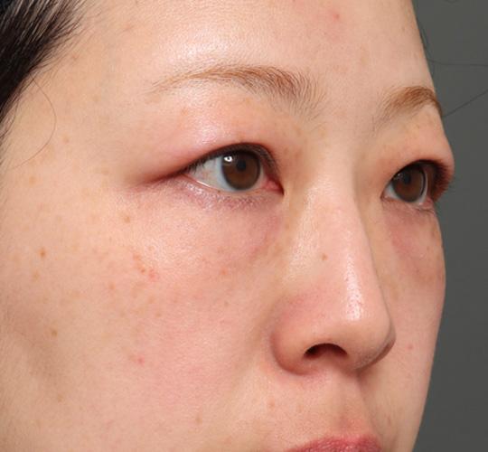 30代女性の3Dリポアイリフト  Before 症例写真