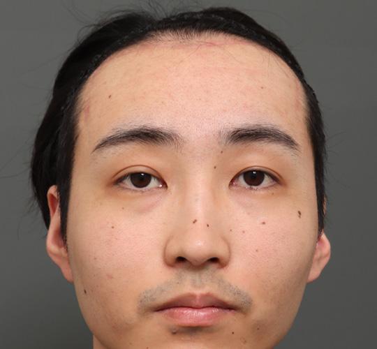 20代男性のエラ・アゴ・小顔 After 症例写真