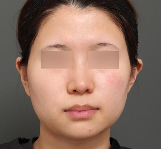 10代女性のバッカルファット除去 After 症例写真