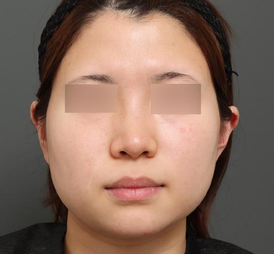 10代女性のバッカルファット除去 Before 症例写真