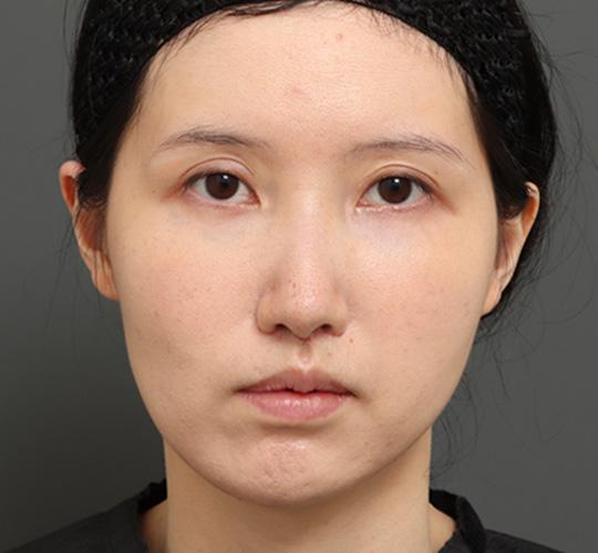 20代女性の顔の脂肪吸引  After 症例写真