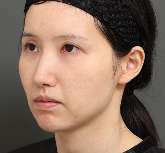 20代女性の顔の脂肪吸引 After 症例写真