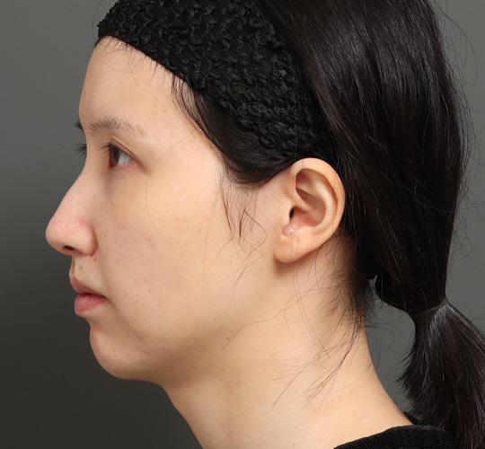 20代女性の顔の脂肪吸引  After 症例写真