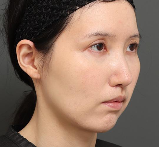 20代女性の顔の脂肪吸引  After 症例写真