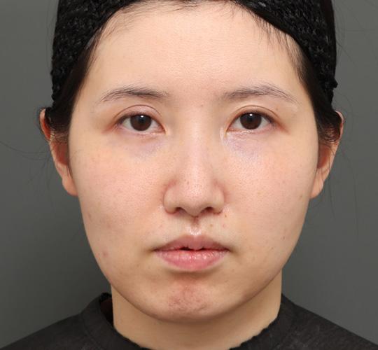 20代女性の顔の脂肪吸引  Before 症例写真