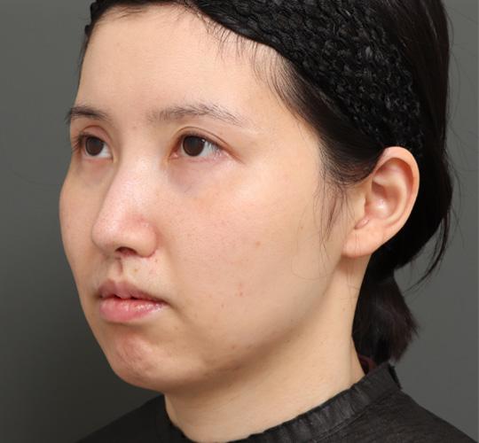 20代女性の顔の脂肪吸引 Before 症例写真