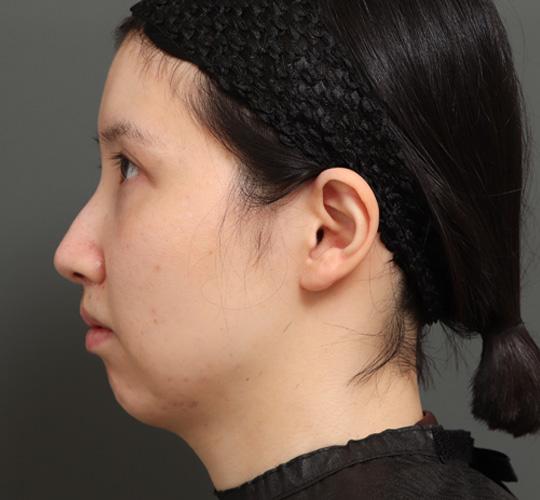 20代女性の顔の脂肪吸引  Before 症例写真