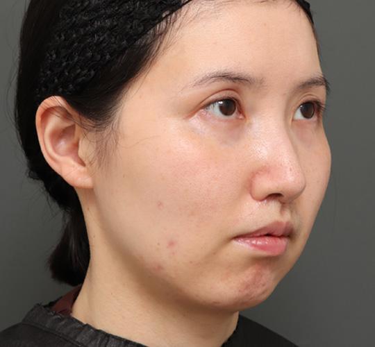 20代女性の顔の脂肪吸引  Before 症例写真