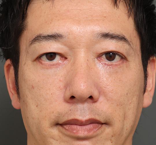 40代男性のミッドフェイスリフト After 症例写真