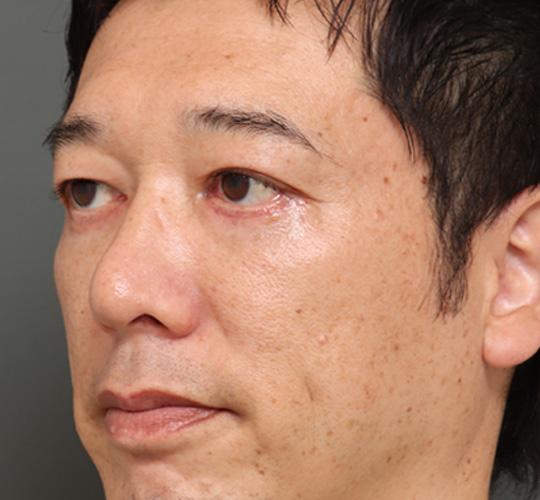 40代男性のハムラ法（目の下のたるみ取り） After 症例写真