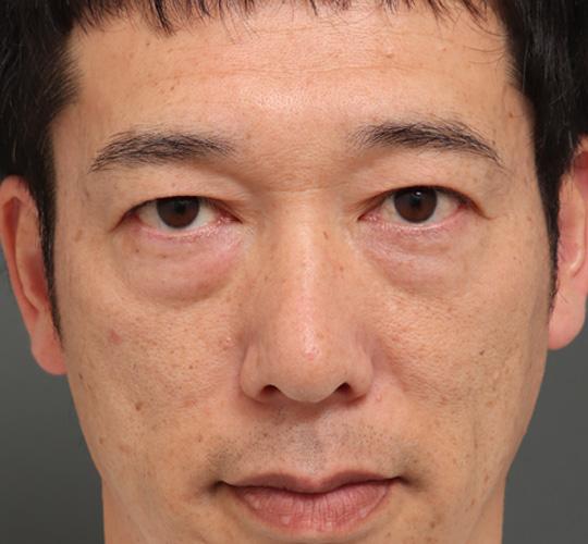 40代男性のミッドフェイスリフト Before 症例写真