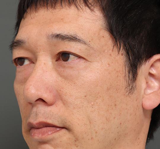 40代男性のハムラ法（目の下のたるみ取り） Before 症例写真