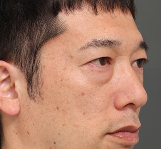40代男性のハムラ法（目の下のたるみ取り） Before 症例写真