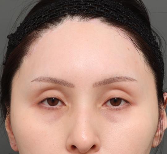 30代女性のエラ・アゴ・小顔 After 症例写真