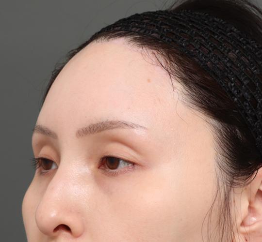 30代女性の額縮小 After 症例写真