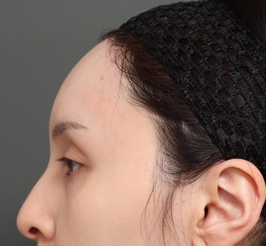 30代女性の額縮小 After 症例写真