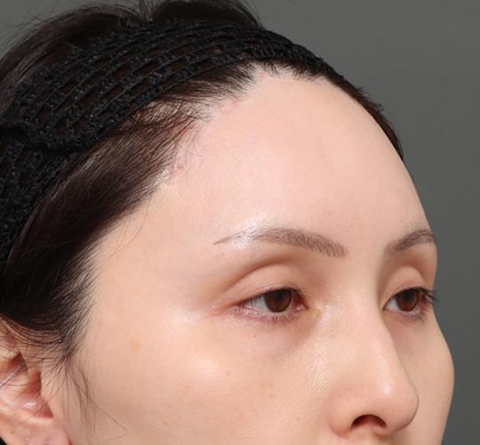 30代女性の額縮小 After 症例写真