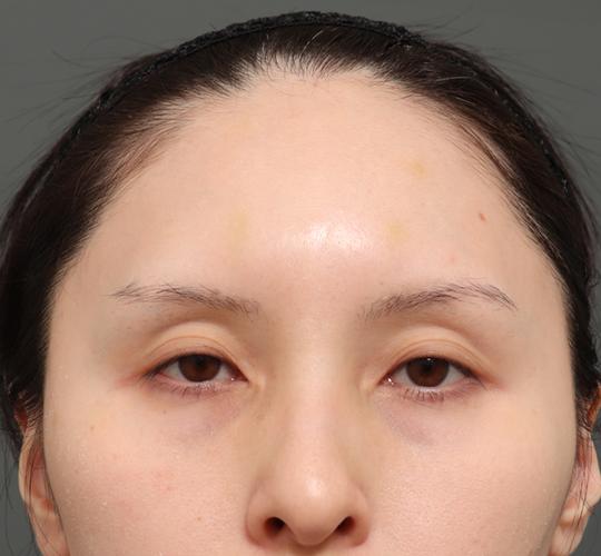 30代女性のエラ・アゴ・小顔 Before 症例写真