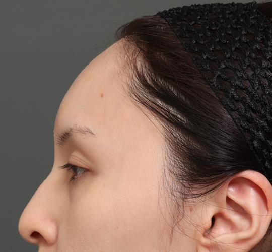 30代女性の額縮小 Before 症例写真