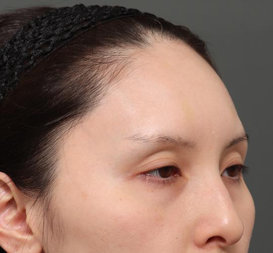 30代女性の額縮小 Before 症例写真