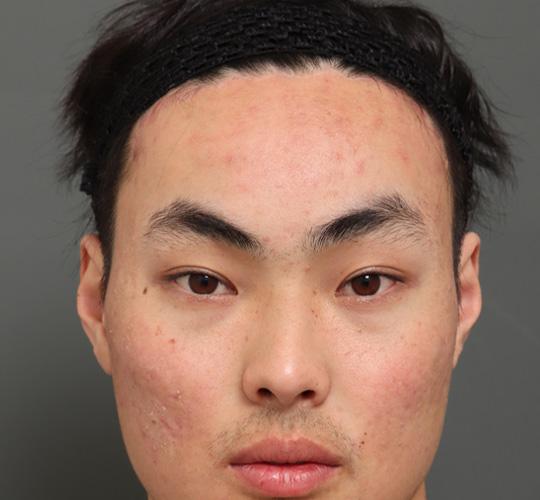 20代男性のエラ・アゴ・小顔 After 症例写真
