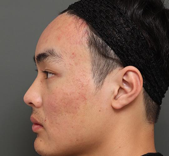 20代男性の額縮小 After 症例写真