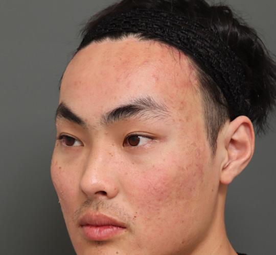 20代男性の額縮小 After 症例写真
