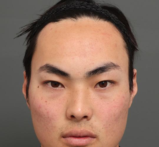 20代男性のエラ・アゴ・小顔 Before 症例写真
