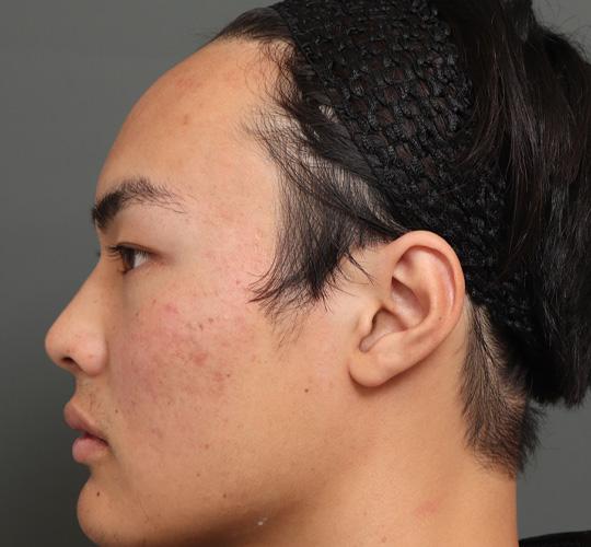 20代男性の額縮小 Before 症例写真