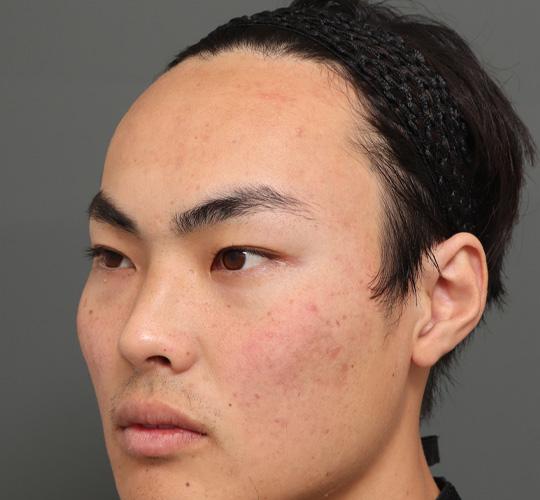 20代男性の額縮小 Before 症例写真