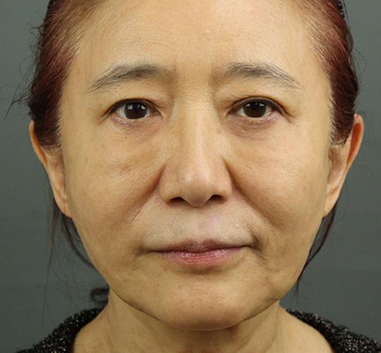 60代女性のアルテミスリフト After 症例写真