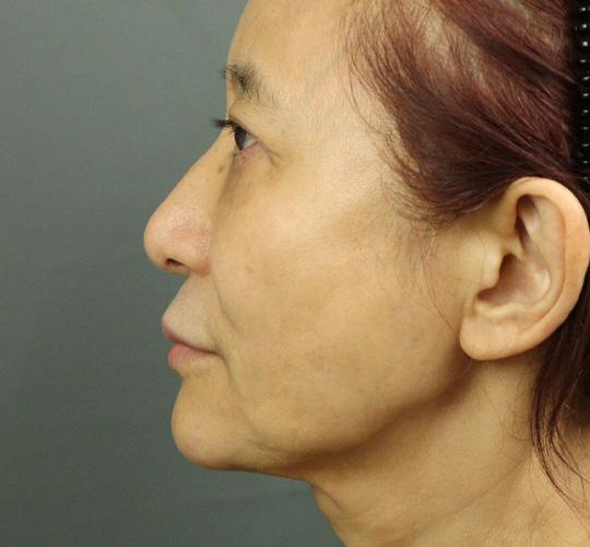 60代女性のアルテミスリフト After 症例写真