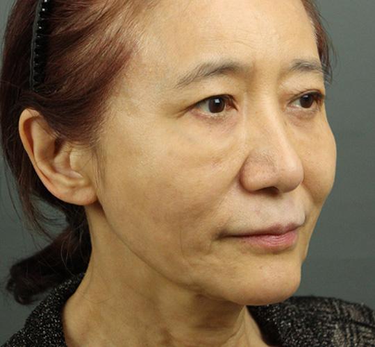 60代女性のエラ・アゴ・小顔 After 症例写真
