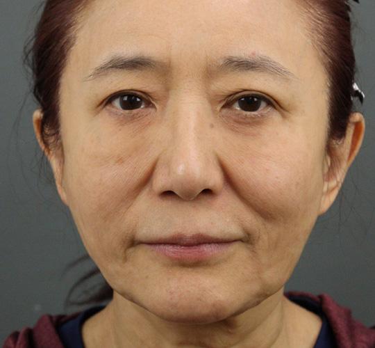 60代女性のアルテミスリフト Before 症例写真