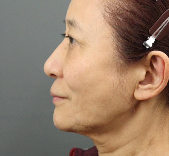 60代女性のアルテミスリフト Before 症例写真