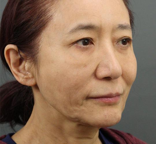 60代女性のエラ・アゴ・小顔 Before 症例写真