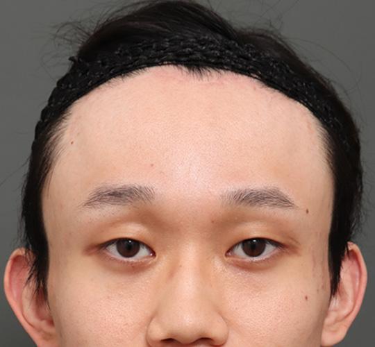 20代男性のエラ・アゴ・小顔 After 症例写真