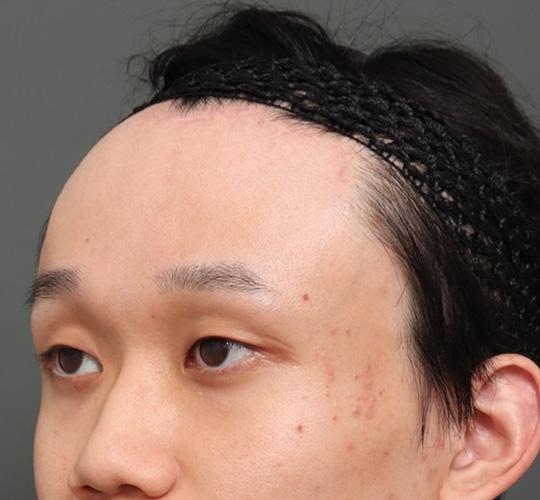 20代男性の額縮小 After 症例写真