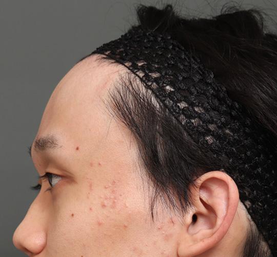 20代男性の額縮小 After 症例写真