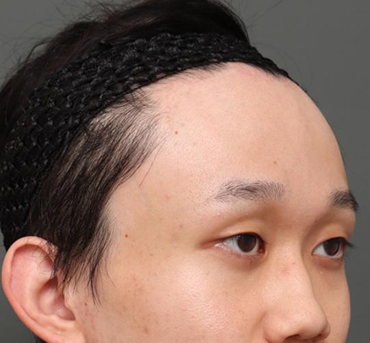 20代男性の額縮小 After 症例写真