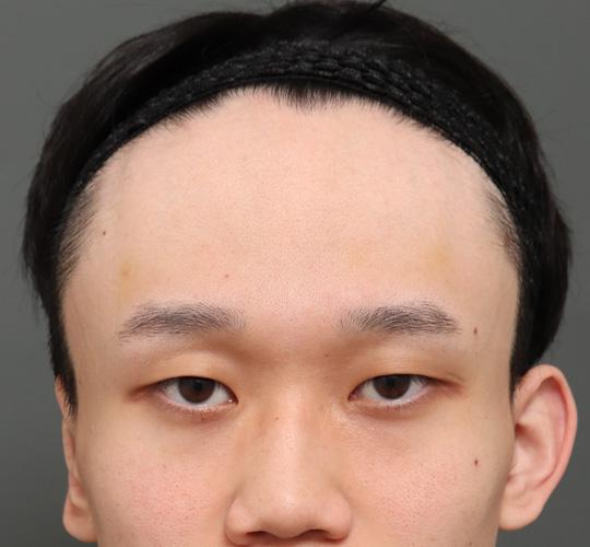 20代男性のエラ・アゴ・小顔 Before 症例写真