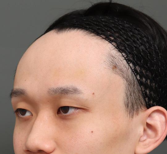 20代男性の額縮小 Before 症例写真