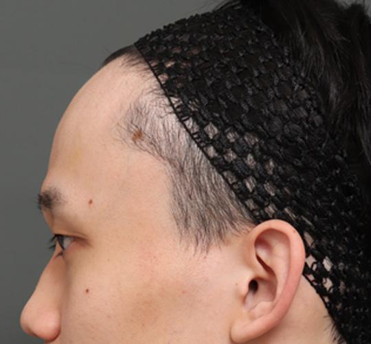 20代男性の額縮小 Before 症例写真